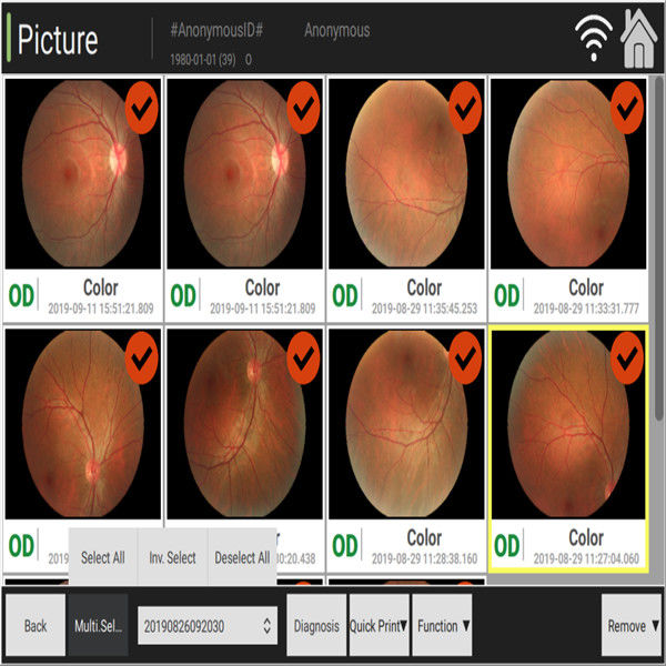 macchina fotografica del fondo automatizzata 3.3mm osservando il cambiamento di colore di atrofia del nervo ottico